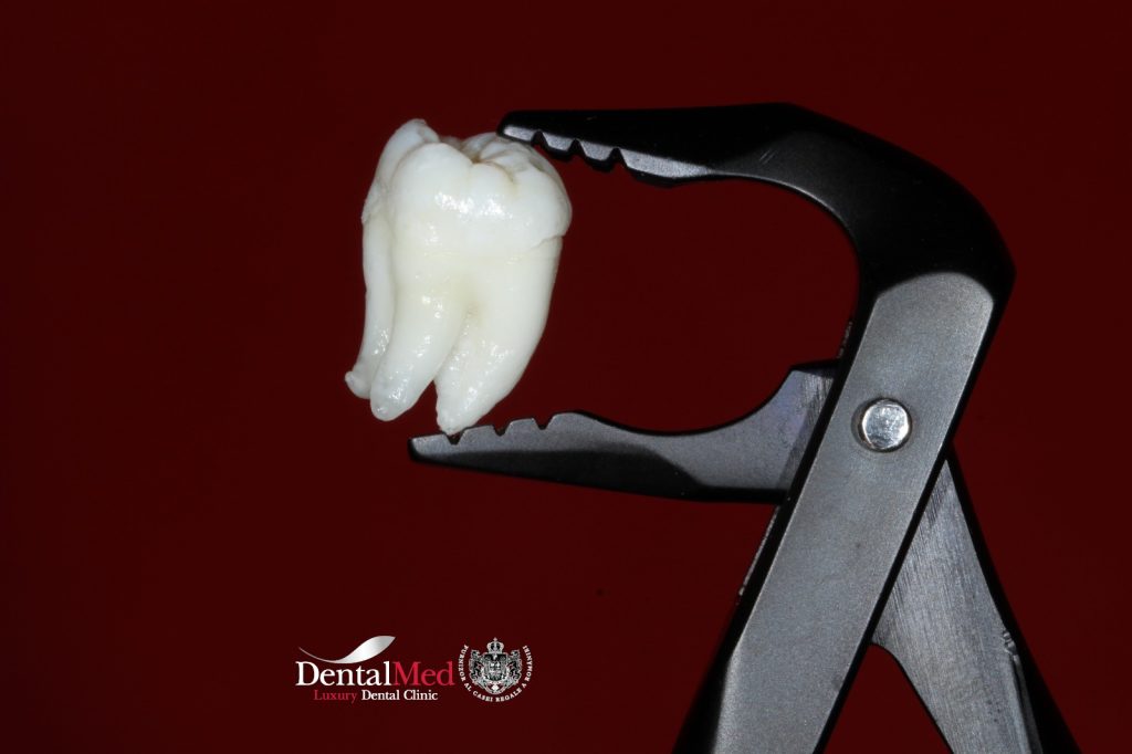 osteointegrare 4 Ce este osteointegrarea implanturilor dentare si de ce este atat de importanta?