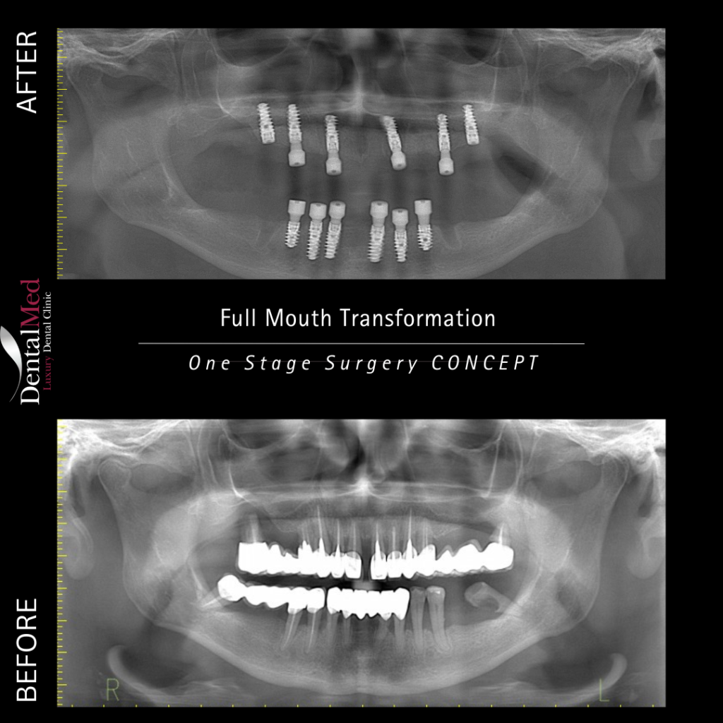 osteointegrare case study1 Ce este osteointegrarea implanturilor dentare si de ce este atat de importanta?