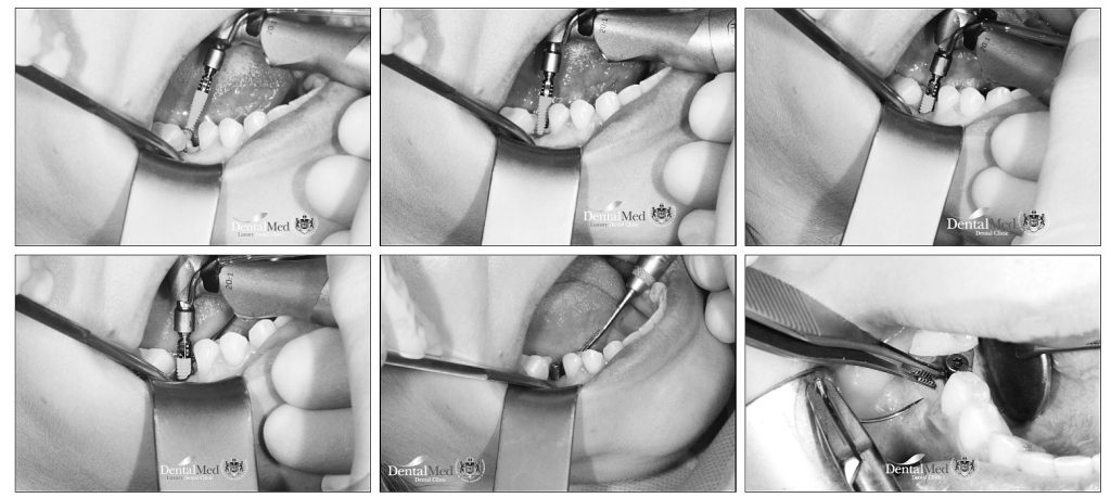 07.10 explantare extractie implant dentar Explantare / extractie implant dentar. Cand este necesara procedura?