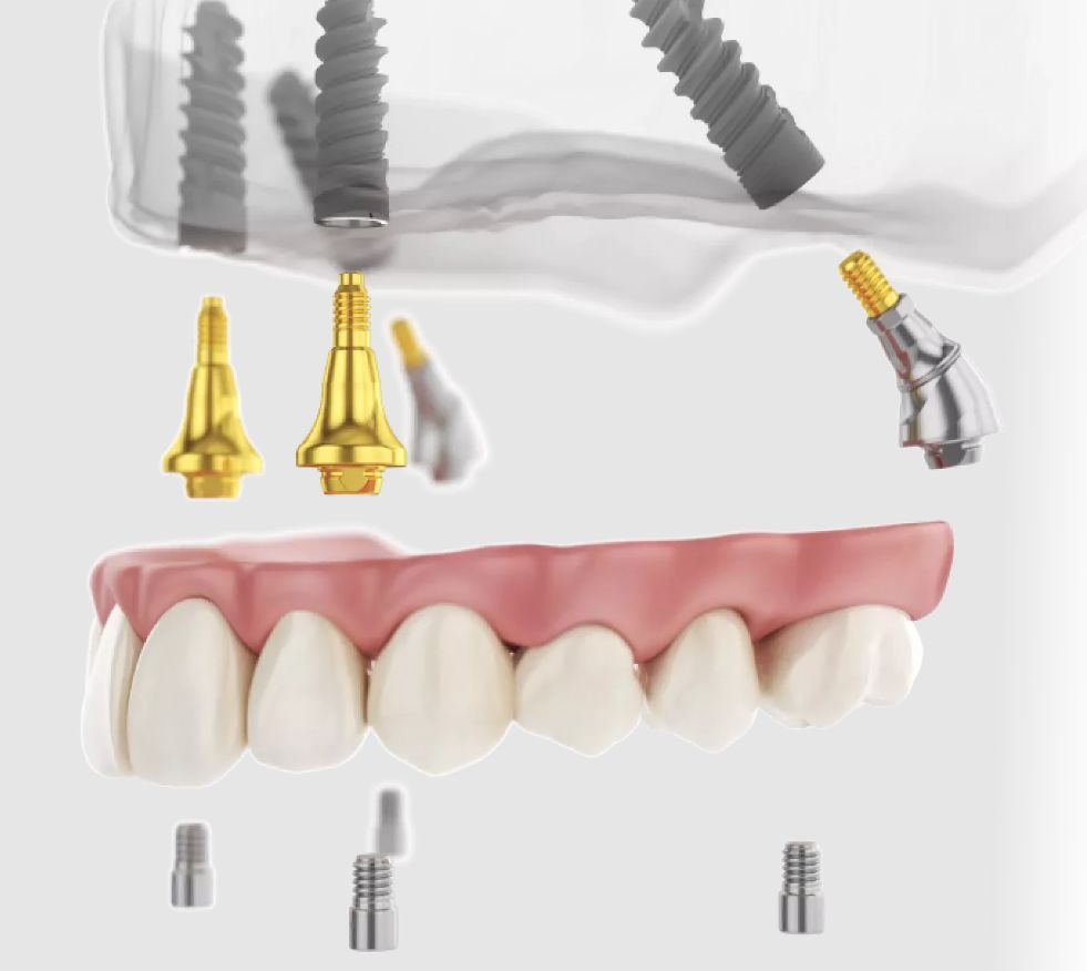08.10 periimplantita 2 Periimplantita. Ce este, care sunt cauzele, simptomele si tratamentul?