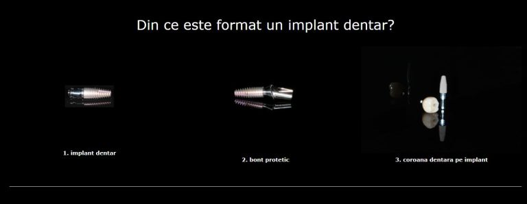 09.10 bont protetic implant dentar 2 Bont protetic implant dentar. Un element esential al interventiei!