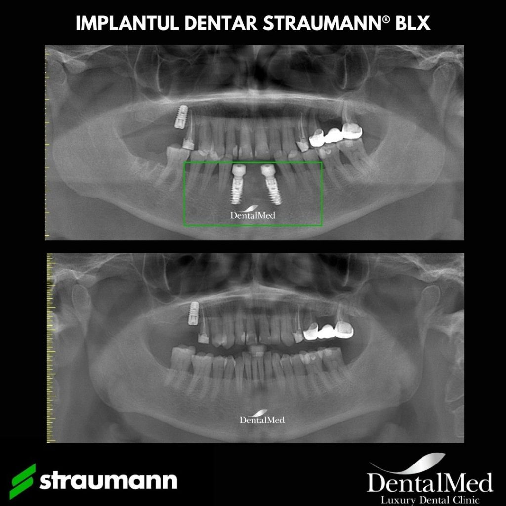 10.10 biocompatibilitate 2 Biocompatibilitatea, esentiala in succesul unui tratament cu implant dentar!
