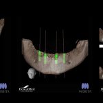 10.10 cbct dentar 2 CBCT dentar. O componenta esentiala in succesul unui implant dentar!