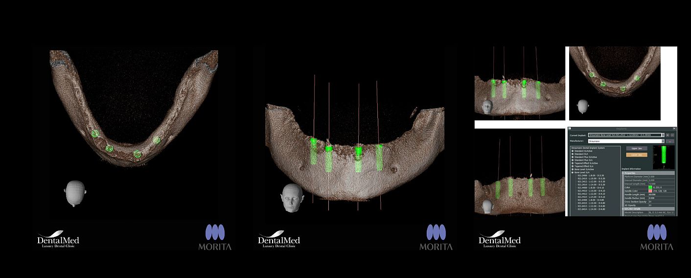 10.10 cbct dentar 2 CBCT dentar. O componenta esentiala in succesul unui implant dentar!