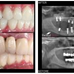 14.10 membrana prf implant dentar Ce este tehnica PRF, esentiala in tratamentele cu implant dentar?