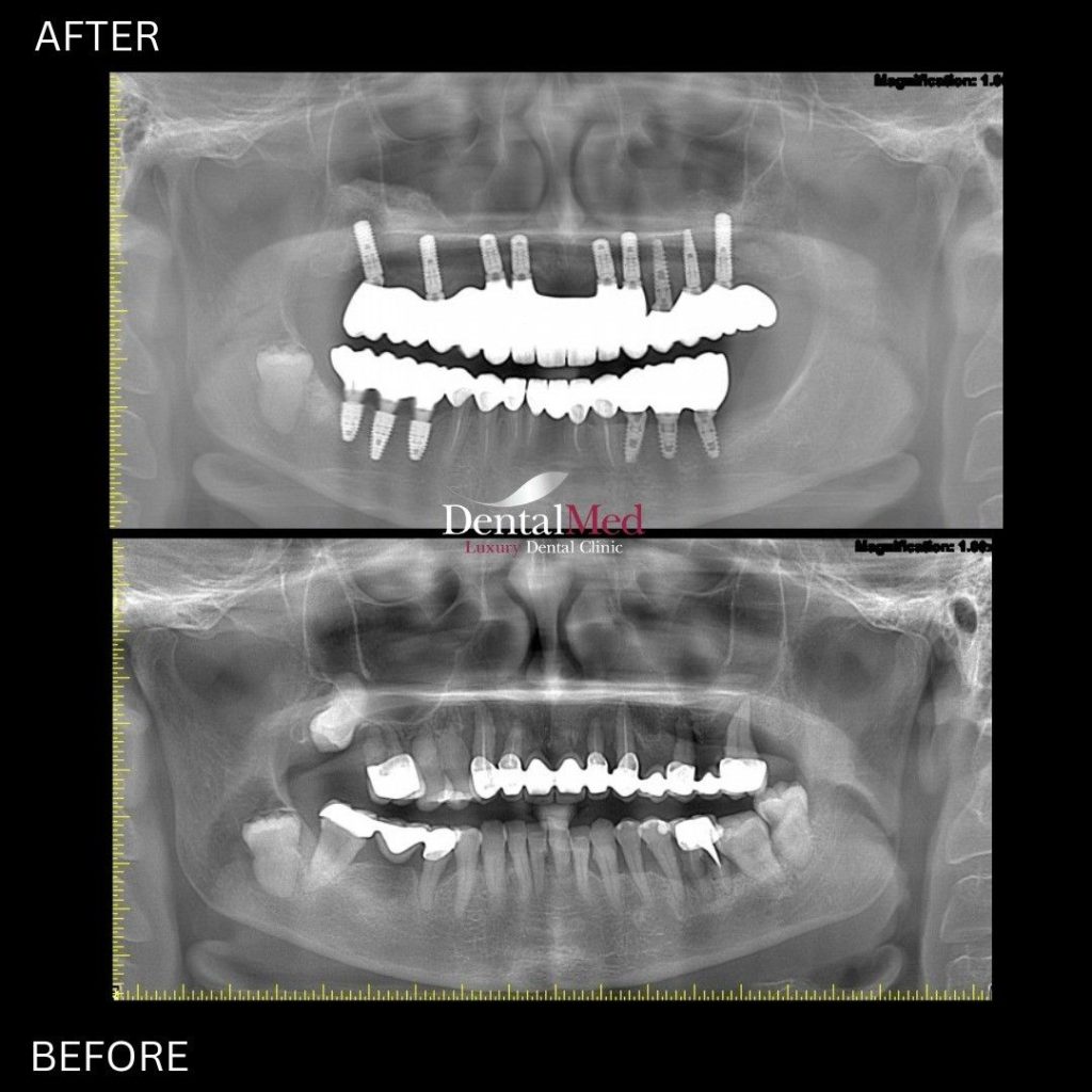 Ce este tehnica PRF, esentiala in tratamentele cu implant dentar? 1 14.10 membrana prf implant dentar 2 Ce este tehnica PRF, esentiala in tratamentele cu implant dentar?