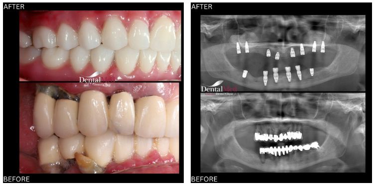 14.10 membrana prf implant dentar Ce este tehnica PRF, esentiala in tratamentele cu implant dentar?