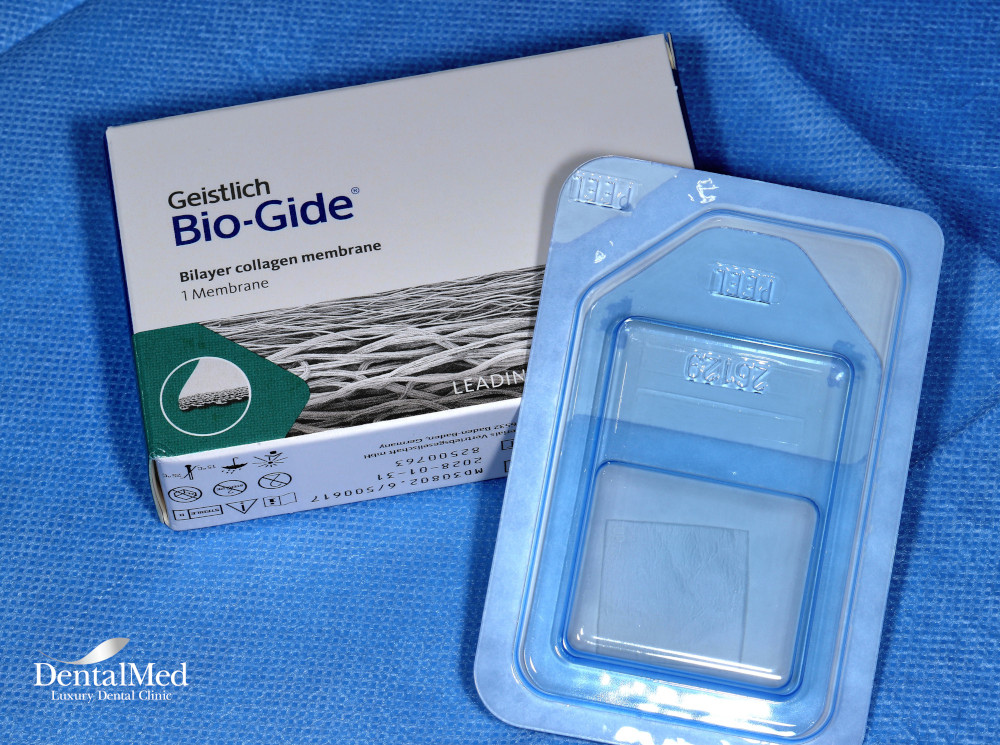 BioGide Collagen Membrane La ce trebuie să fim atenți când căutăm un medic parodontolog bun în București?