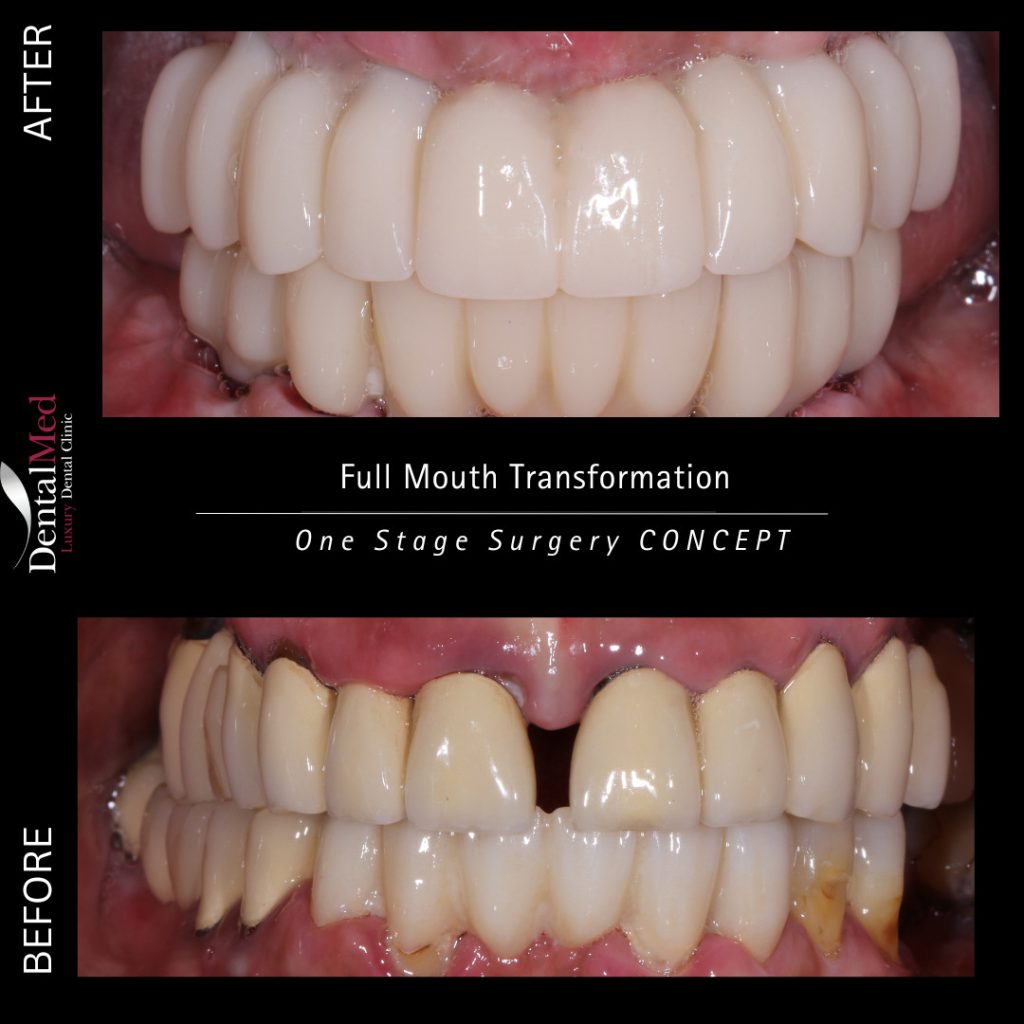 img2 Implantul dentar, cea mai buna solutie de reconstructie dinte!