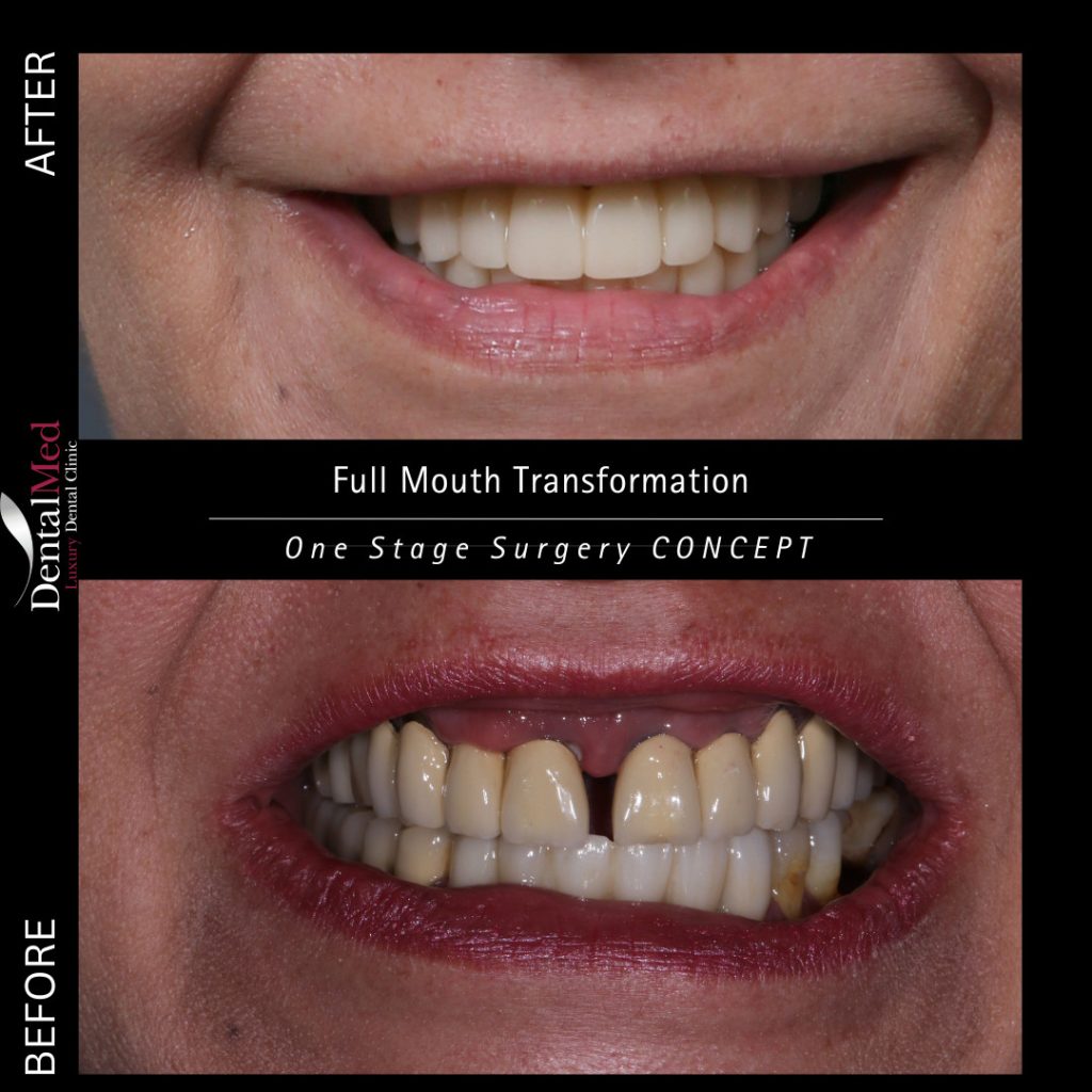 img4 Implantul dentar, cea mai buna solutie de reconstructie dinte!