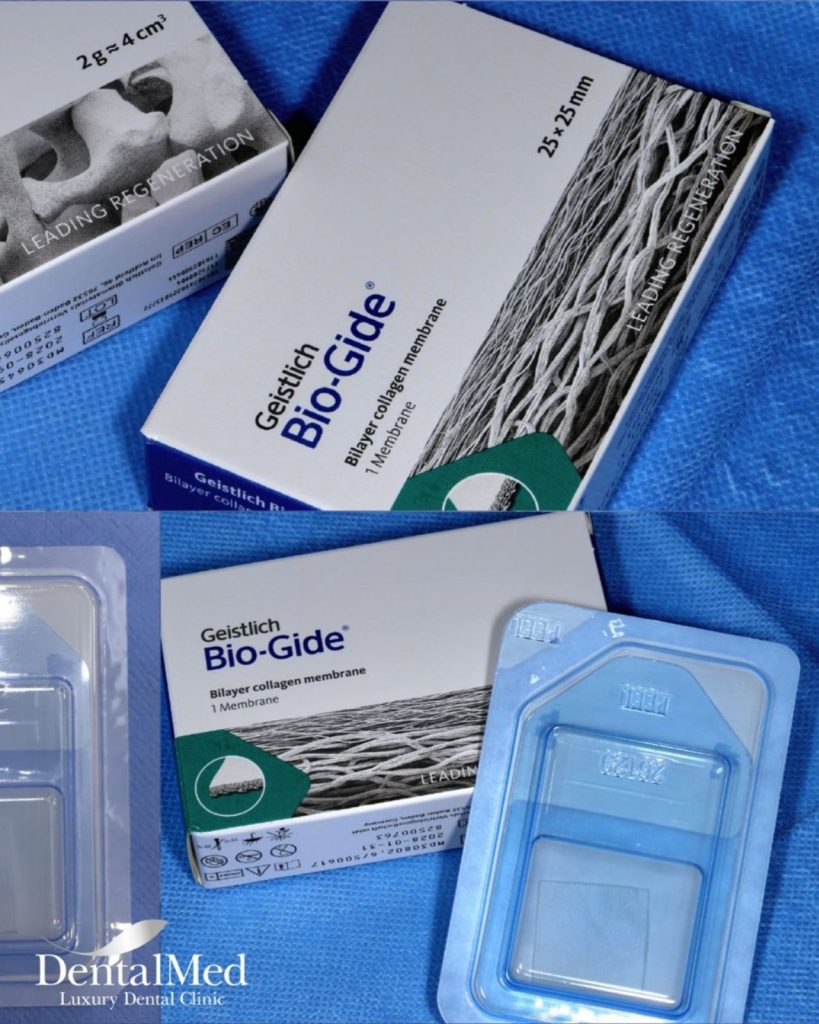 06.11 sinus lift implant dentar.jpg 2 Sinus lift implant dentar. Ce este aceasta procedura si cand e necesara?