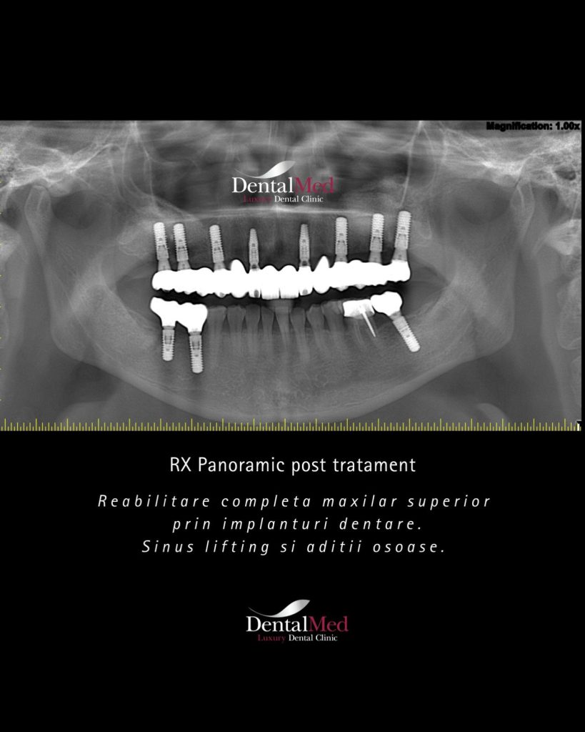 06.11 sinus lift implant dentar.jpg Sinus lift implant dentar. Ce este aceasta procedura si cand e necesara?