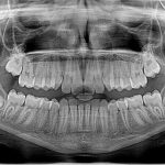 07.11 radiografia panoramica 2 Radiografia panoramica, esentiala inainte si dupa un implant dentar!