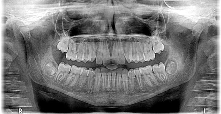 07.11 radiografia panoramica 2 Radiografia panoramica, esentiala inainte si dupa un implant dentar!