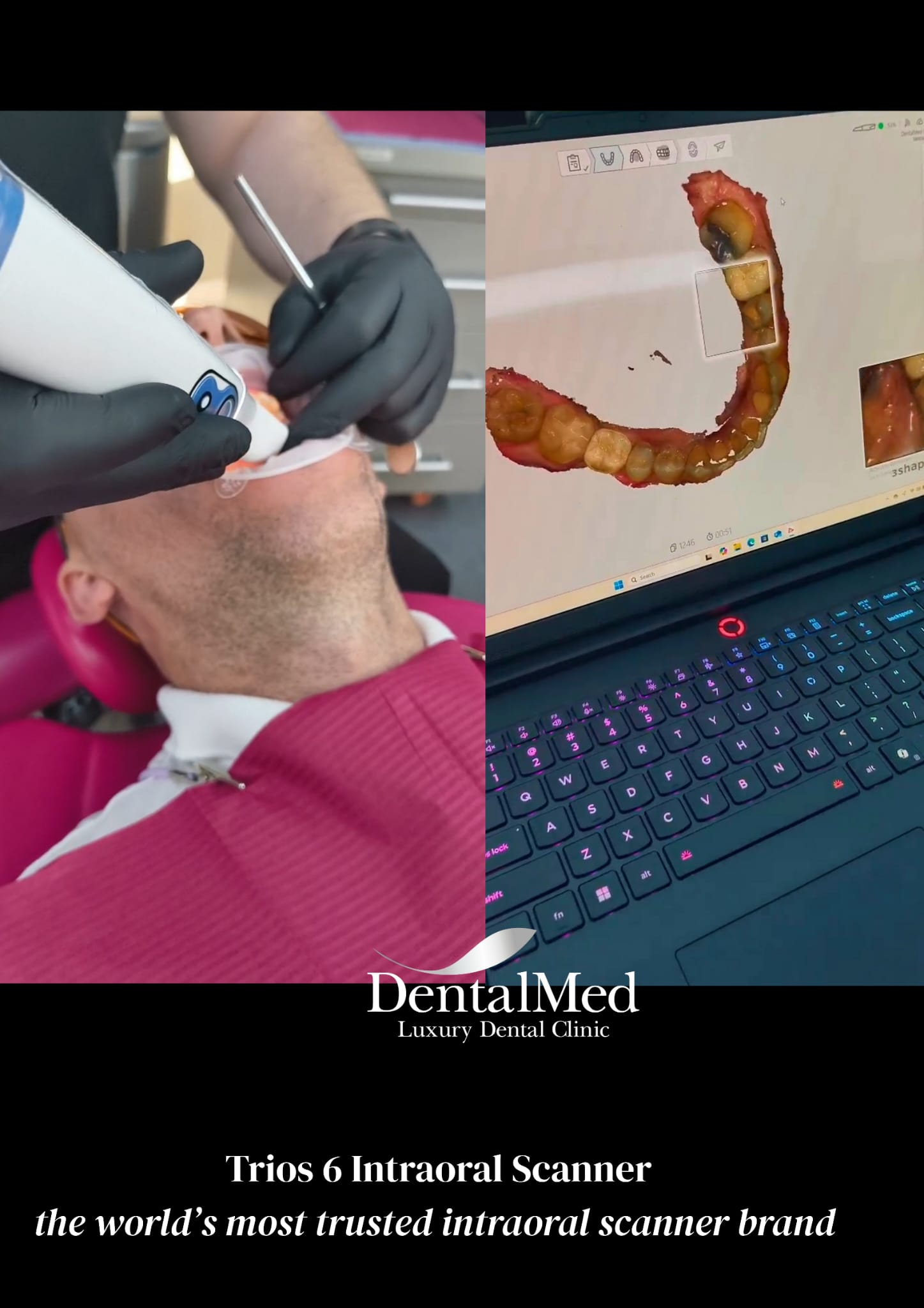 Scanare intraorala implant dentar. Ce este si ce rol are aceasta procedura? 1 scanner intraoral trios 6 4 Scanare intraorala implant dentar. Ce este si ce rol are aceasta procedura?