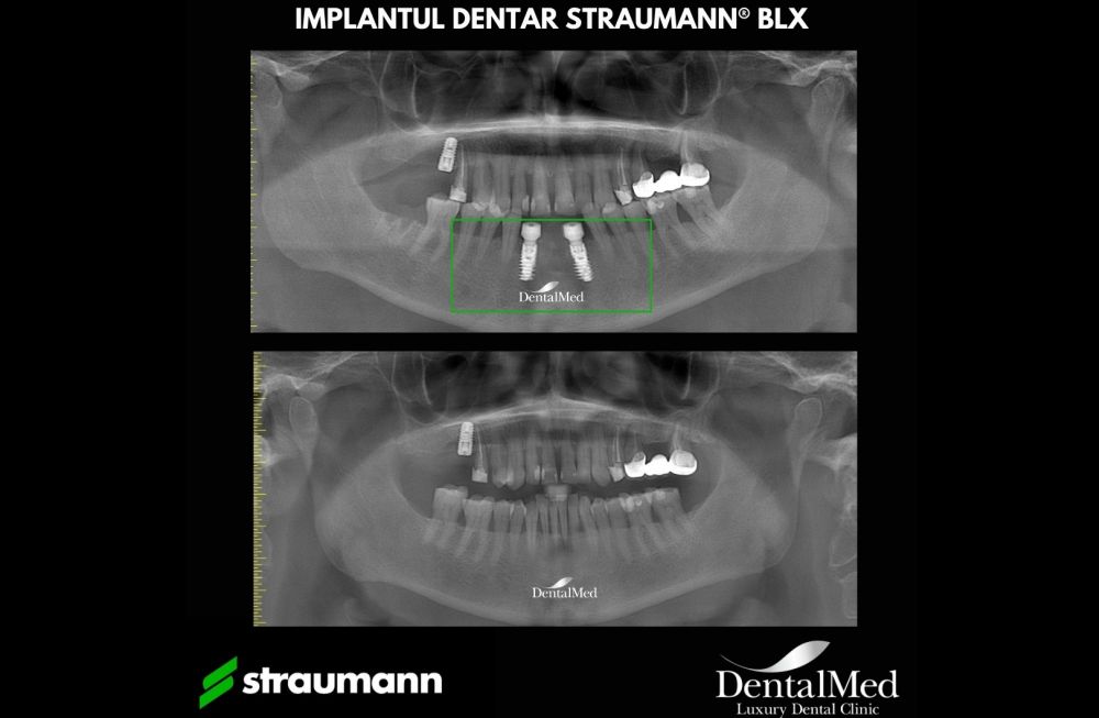 Ce este Roxolid, materialul pentru implant dentar creat de Straumann? 1 08.12 straumann roxolid implant dentar Ce este Roxolid, materialul pentru implant dentar creat de Straumann?