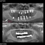 Studiu de caz: reconstructie totala cu implanturi dentare Straumann SLA, la pacientii in varsta 3 11.12 implanturi dentare straumann sla Studiu de caz: reconstructie totala cu implanturi dentare Straumann SLA, la pacientii in varsta