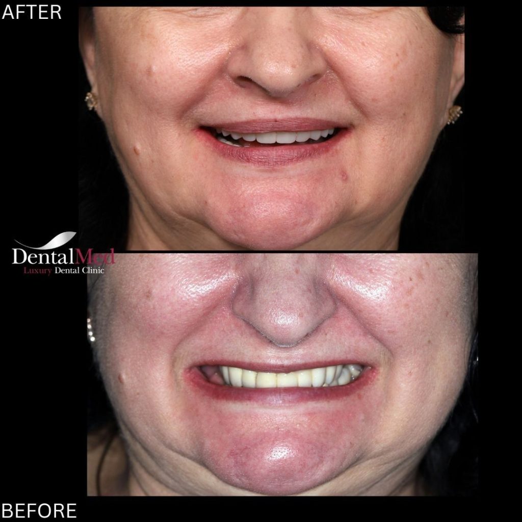 Studiu de caz: reconstructie totala cu implanturi dentare Straumann SLA, la pacientii in varsta 1 11.12 implanturi dentare straumann sla 2 Studiu de caz: reconstructie totala cu implanturi dentare Straumann SLA, la pacientii in varsta