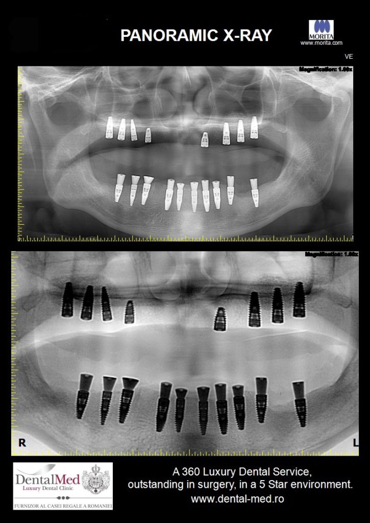Airflow dentar atunci cand ai implanturi. La ce trebuie sa fii atent? 1 12.12 airflow dentar implanturi 2 Airflow dentar atunci cand ai implanturi. La ce trebuie sa fii atent?