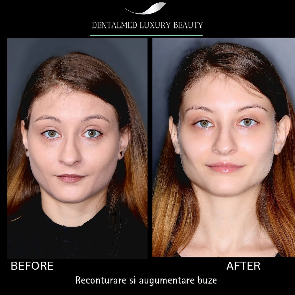 Estetica faciala Bucuresti 11 Cazuri pacienti 20260206 194757 0000 Estetica faciala Bucuresti