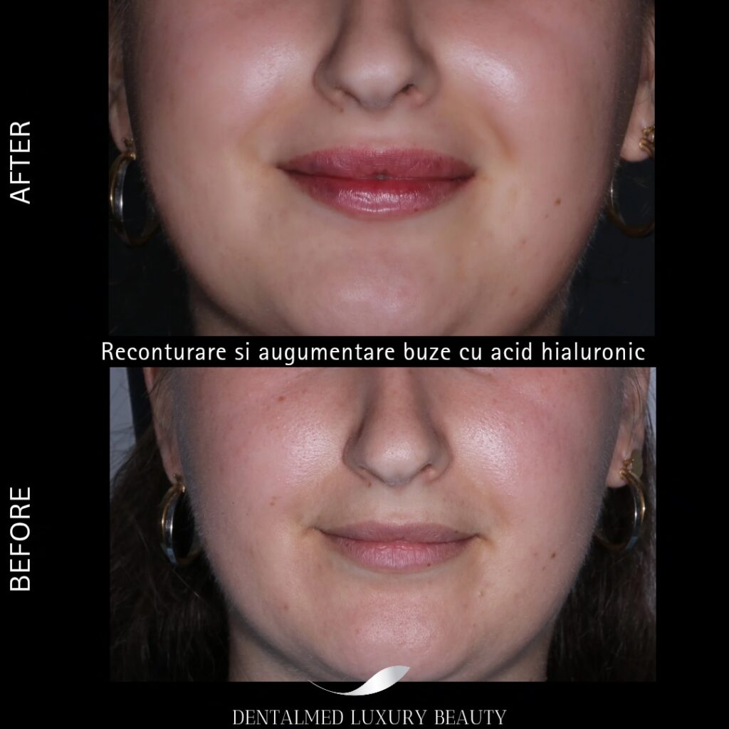 Estetica faciala Bucuresti 8 Cazuri pacienti 20260206 202217 0001 Estetica faciala Bucuresti