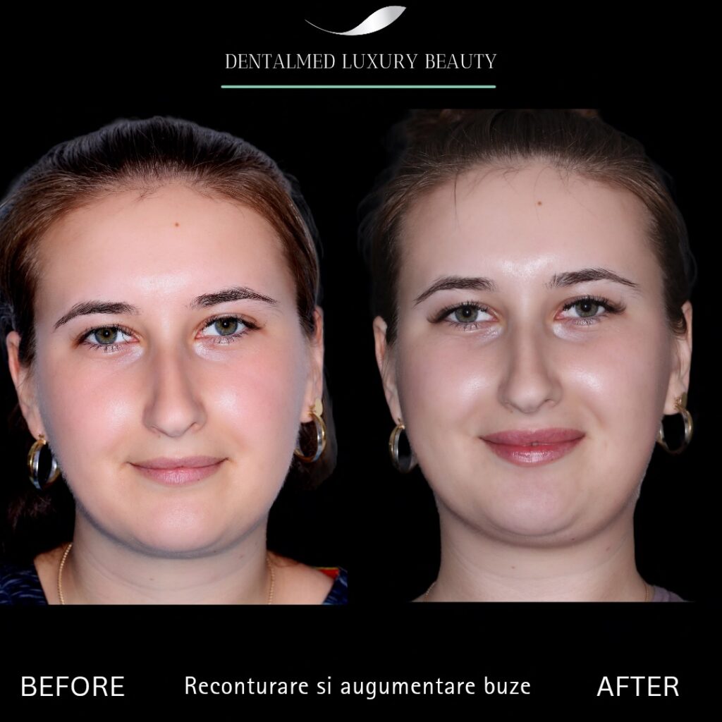 Estetica faciala Bucuresti 7 Cazuri pacienti 20260206 204341 0000 Estetica faciala Bucuresti