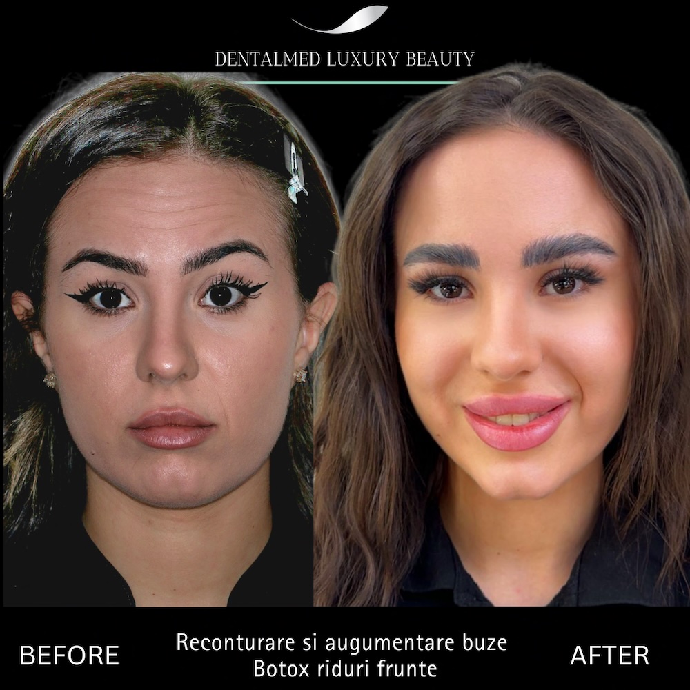 Estetica faciala Bucuresti 6 Matei Florentina hialuronic 20260310 213459 0000 Estetica faciala Bucuresti