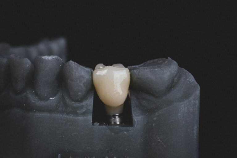 implant dentar contraindicatii Cazurile în care implantul dentar nu se poate face imediat și ce soluții există