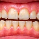 Microtraumele zilnice îți afectează dinții fără să îți dai seama 5 Microtraumele zilnice iti afecteaza dintii 2 Microtraumele zilnice îți afectează dinții fără să îți dai seama