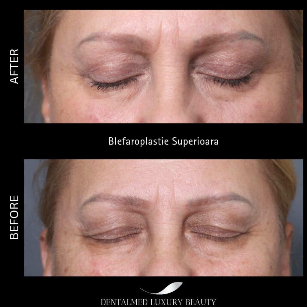 Blefaroplastie în București – Reîntinerește privirea la clinica Dentalmed 2 blefaroplastia Blefaroplastie în București – Reîntinerește privirea la clinica Dentalmed