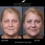 Blefaroplastie în București – Reîntinerește privirea la clinica Dentalmed 2 blefaroplastie bucuresti Blefaroplastie în București – Reîntinerește privirea la clinica Dentalmed