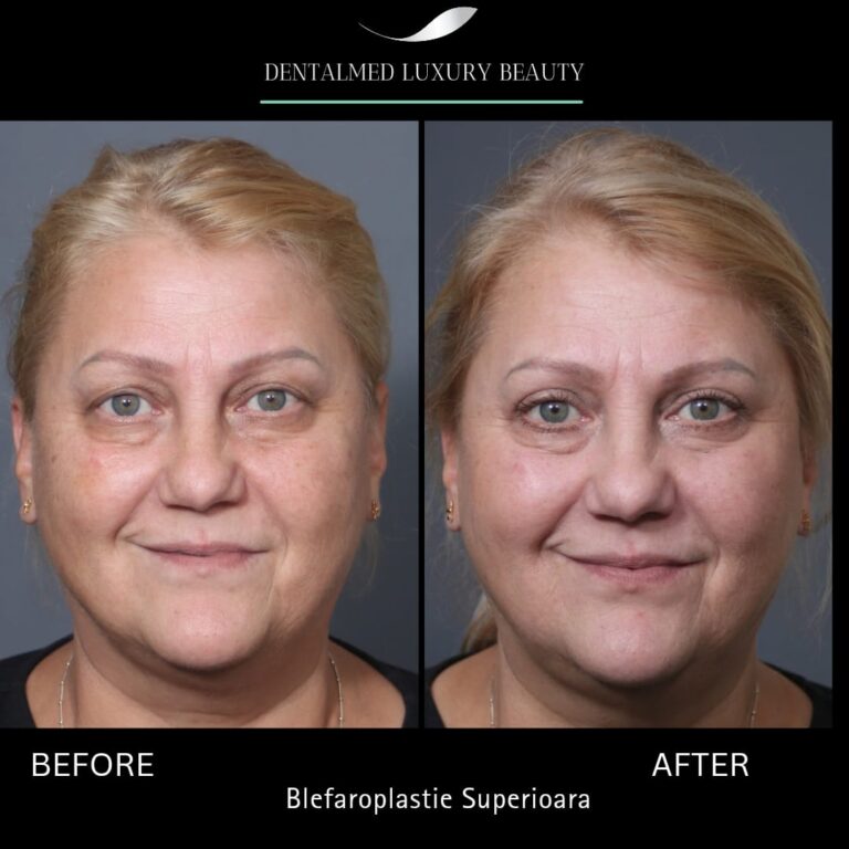 blefaroplastie bucuresti Blefaroplastie în București – Reîntinerește privirea la clinica Dentalmed