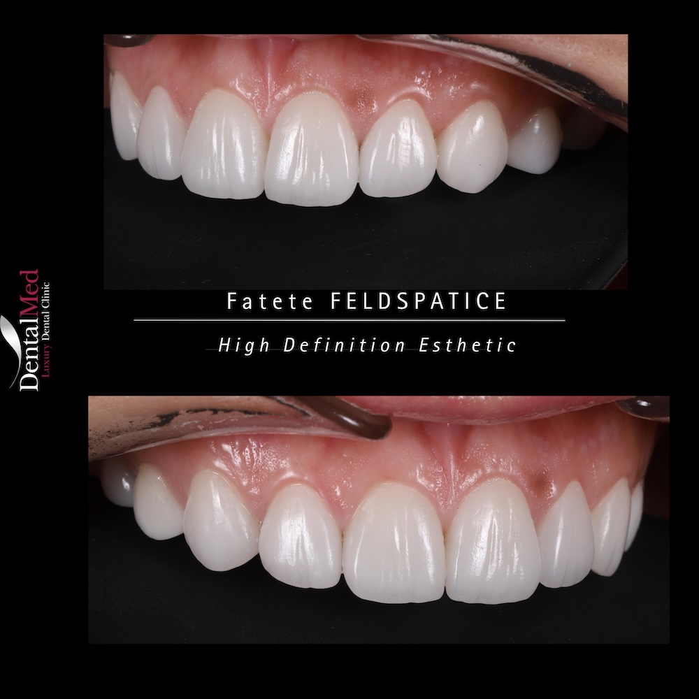 Fațete și coroane feldspatice – soluția premium pentru un zâmbet natural 4 Before After Coroane Feldspatice 4 Fațete și coroane feldspatice – soluția premium pentru un zâmbet natural