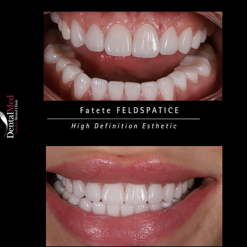 Fațete și coroane feldspatice – soluția premium pentru un zâmbet natural 5 Before After Coroane Feldspatice 5 Fațete și coroane feldspatice – soluția premium pentru un zâmbet natural