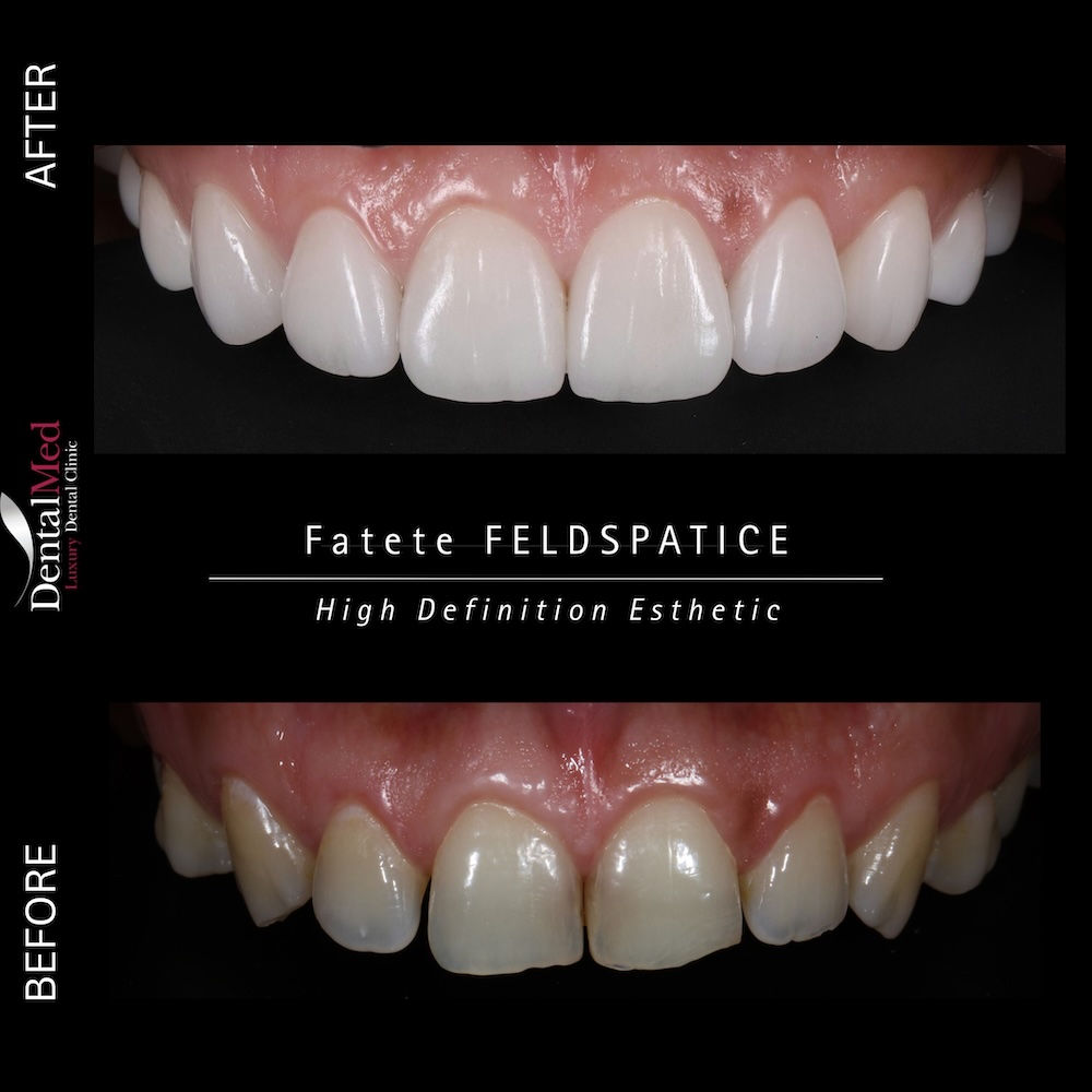 Fațete și coroane feldspatice – soluția premium pentru un zâmbet natural 3 Before After Coroane Feldspatice Fațete și coroane feldspatice – soluția premium pentru un zâmbet natural