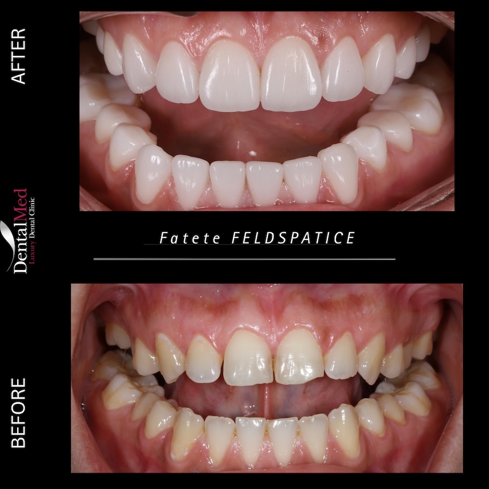 Fațete și coroane feldspatice – soluția premium pentru un zâmbet natural 1 Before After coroane Feldspatice 2 Fațete și coroane feldspatice – soluția premium pentru un zâmbet natural