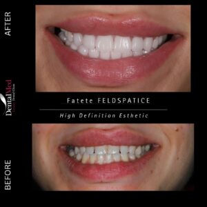 Fațete și coroane feldspatice – soluția premium pentru un zâmbet natural 7 coroane feldspaltice Fațete și coroane feldspatice – soluția premium pentru un zâmbet natural
