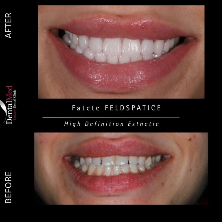 coroane feldspaltice Fațete și coroane feldspatice – soluția premium pentru un zâmbet natural