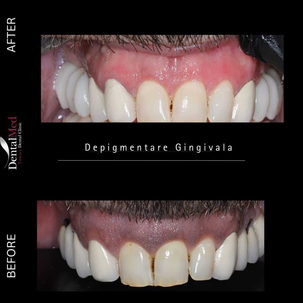 Depigmentarea gingivală – Albirea gingiilor pentru un zâmbet estetic și sănătos 1 depigmentare gingivala laser Depigmentarea gingivală – Albirea gingiilor pentru un zâmbet estetic și sănătos