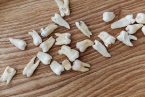 Ce este avulsia dentară și de ce este o urgență stomatologică: pierderea completă a unui dinte și pașii corecți în caz de urgență 2 ce este avulsia dentara 1 Ce este avulsia dentară și de ce este o urgență stomatologică: pierderea completă a unui dinte și pașii corecți în caz de urgență
