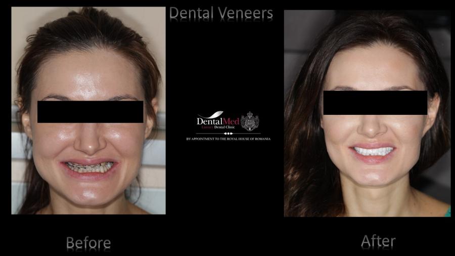 Case%20study%202%20dental%20veneers%20picture%20280 Estetica dentara si protetica - coroana si proteza dentara