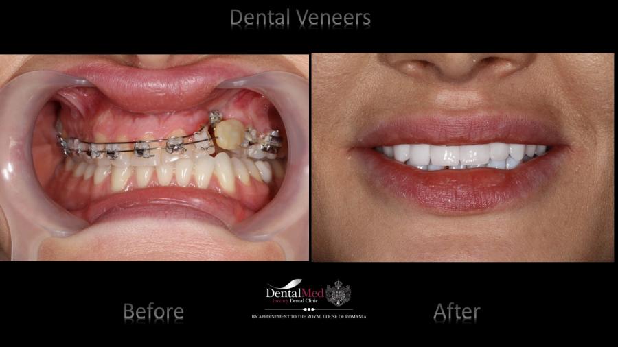 Case%20study%202%20dental%20veneers Protetica dentara si estetica dentara Bucuresti