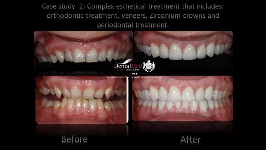 Case%20study%202%20monica%20sechelariu%20before%20and%20afer%20plansa%20RO%20296 Protetica dentara si estetica dentara Bucuresti