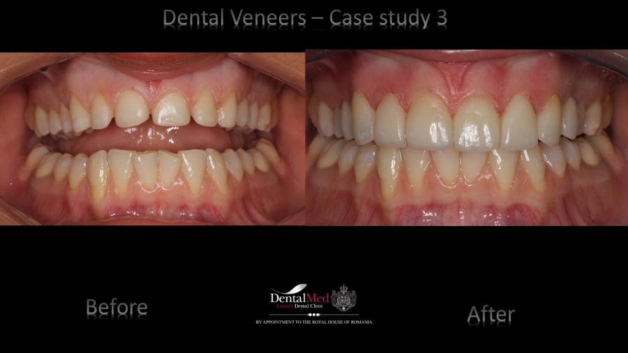 Case%20study%203%20dental%20veneers%20picture%202 Estetica dentara si protetica - coroana si proteza dentara