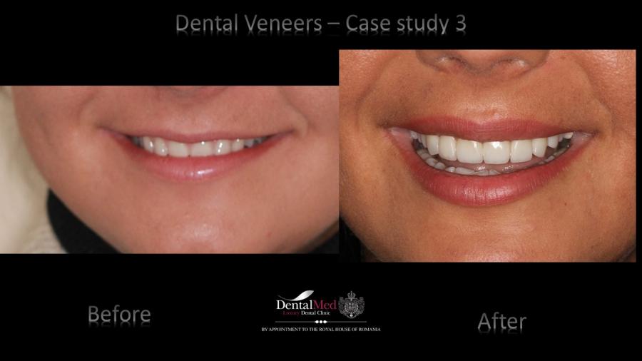 Case%20study%203%20dental%20veneers%20picture%203 Protetica dentara si estetica dentara Bucuresti