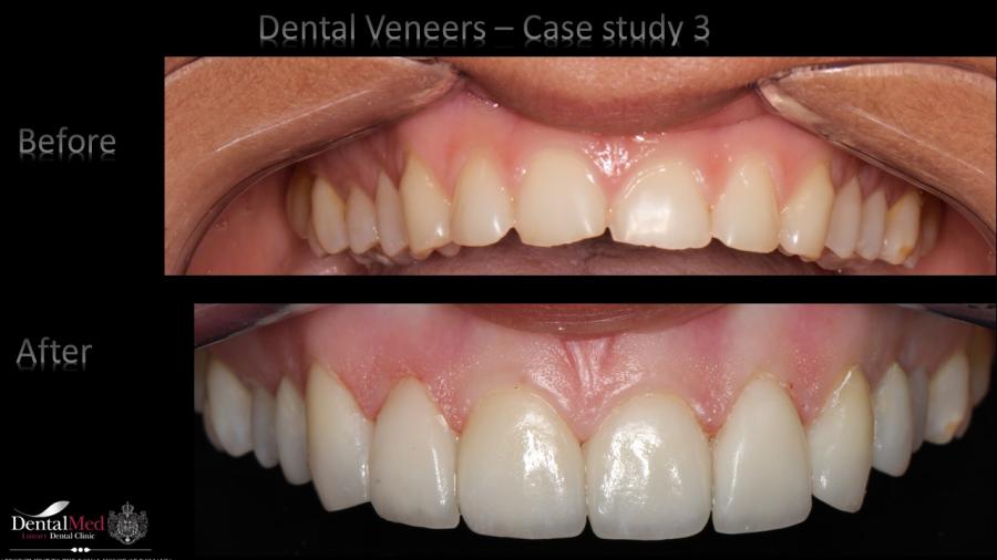 Case%20study%203%20dental%20veneers%20picture%204 Estetica dentara si protetica - coroana si proteza dentara