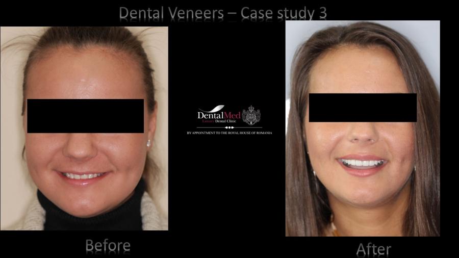 Case%20study%203%20dental%20veneers Protetica dentara si estetica dentara Bucuresti