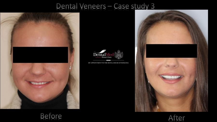 Case%20study%203%20dental%20veneers Estetica dentara si protetica - coroana si proteza dentara