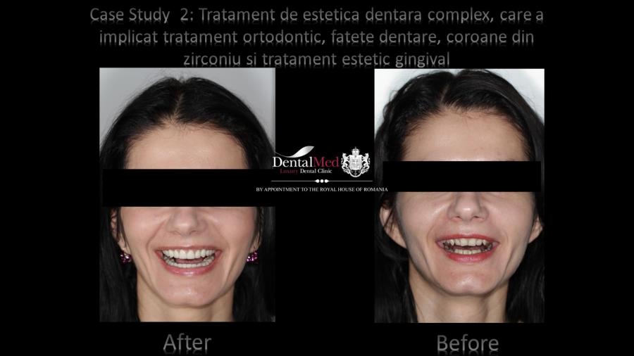 Case%20study%20monica%20sechelariu%20before%20and%20afer%20plansa%20RO Protetica dentara si estetica dentara Bucuresti