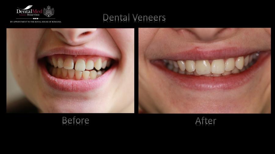 Dotari%20DentalMed march%202016 Estetica dentara si protetica - coroana si proteza dentara